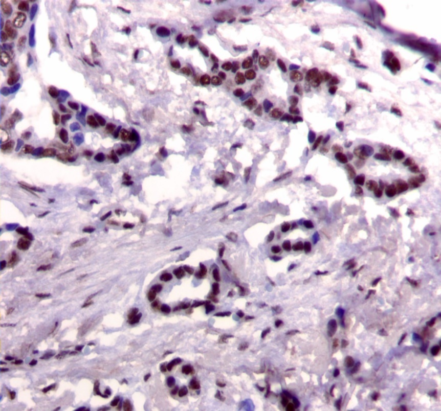 Nuclear staining pattern for IRS-1. (IRS-1 immunohistochemical stain, 200x magnification)