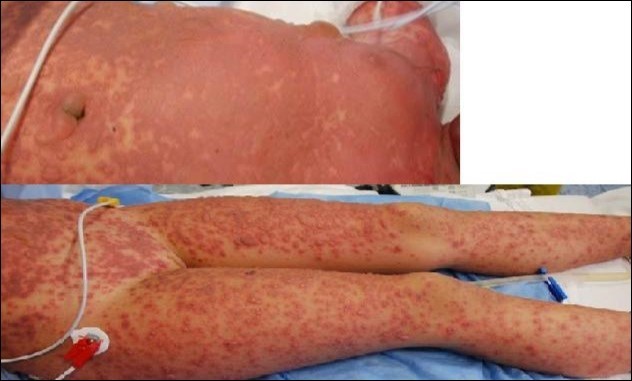Emergency care of Lyell onset. Skin lesions were involving 100% TBSA. Here we see the typical aspect at trunk and arms level.