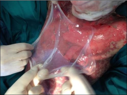 Application of Amniotic Membrane (AM) on chest level after surgical debridement.