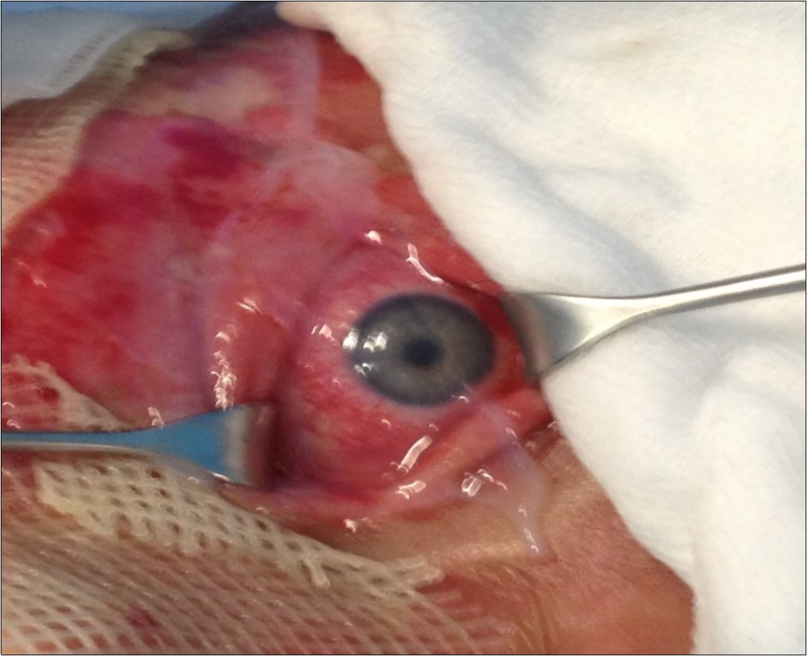 Typical aspect of eye damage in Lyell syndrome. Please note application of Amniotic Membrane surrounding that area and it was also applied for eye restoration.