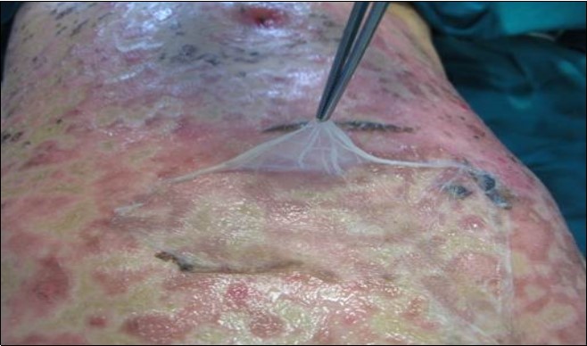 Aspect of Amniotic Membrane at 7 day after surgery with skin healing. A part of AM was retain for histological consideration.