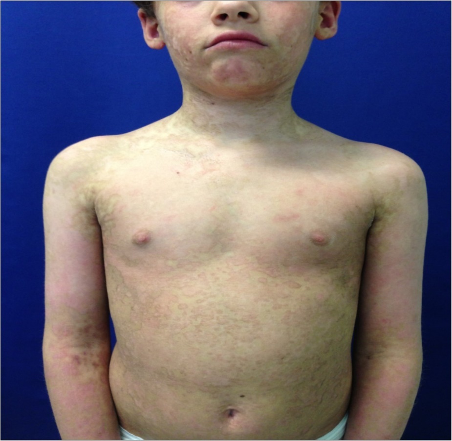 Six months follow up . Here we note trunk and neck with no scar evidence. Skin hyperemia and dyschromia are still present but with satisfactory cosmetic result and progressive regression.