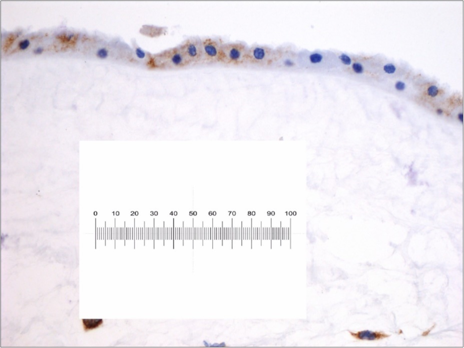Immunochemistry findings on a native Amniotic Membrane retain before application on damaged skin. It’s possible to evaluate its structure with double layer with avascular stroma . The blue marked cell are positively to CD34+ stain as hematopoietic stem cell progenitor. Scale bar 1MM/0.01 mm.