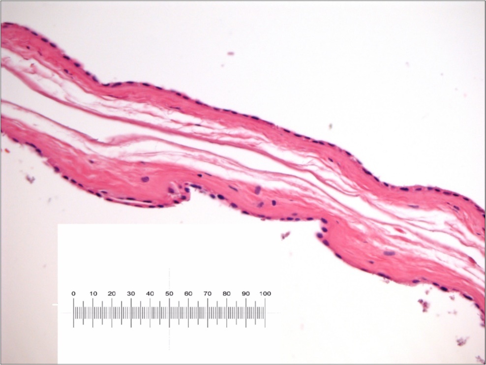 Amniotic Membrane after remove in advanced epithelization. Please note conservation of its cytological pattern : epithelial layer, thick basement membrane and vascular connective tissue layer. No particular inflammatory response was evident. Scale bar 1MM/0.01 mm.