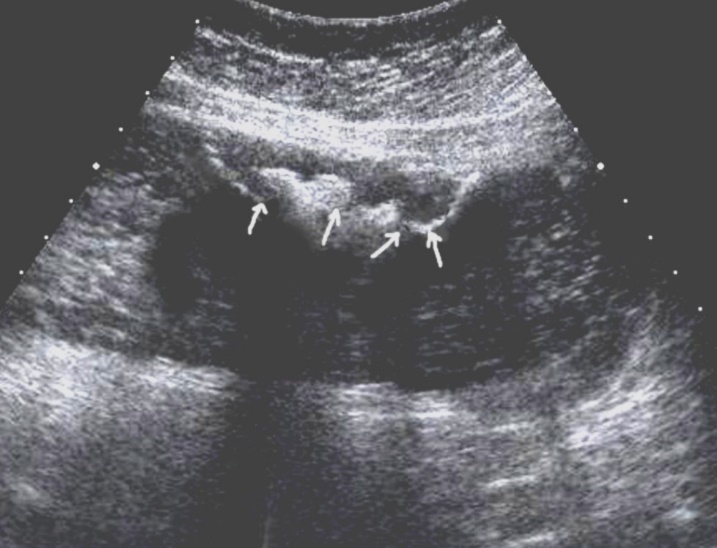 Gastric carcinomas of ulcerating forms in the anterior wall of the stomach body of stage T3. Tumor is manifested with raised margins surrounded by a thickened gastric wall without clear margins.