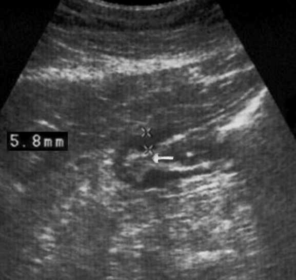 Gastric carcinomas of diffuse infiltrative form in the atrium of T2 stage. Compensated pyloric stenos. On an empty stomach in the cavity of the stomach is determined an a small amount of fluid. The diameter of the pyloric canal more than 7 mm.