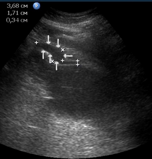 Distal gastric carcinomas of diffuse infiltrative form of T3 stage. Sub compensated pyloric stenos (arrows). The thickness of the anterior wall of the stomach is 9,13 mm, extent of the affected area – 7,84 cm. On an empty stomach in the cavity of the stomach is determined an a large amount of fluid. The diameter of the pyloric canal is about 6 mm.