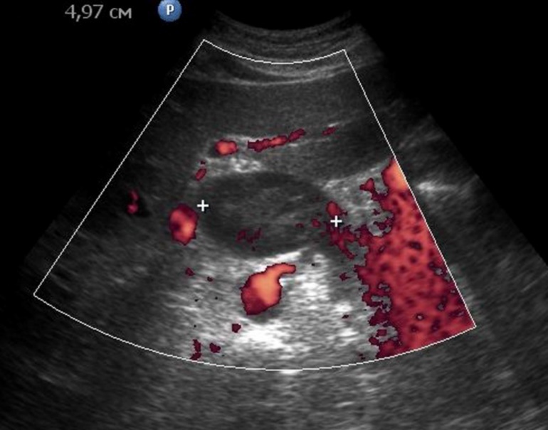Metastasis to the retroperitoneal lymph node in gastric cancer of the antrum of T3 stage. The longitudinal size of the lymph node is increased to 5 cm, the echo is significantly reduced, along the periphery of it is visible color vascular signals in tissue Doppler mode.