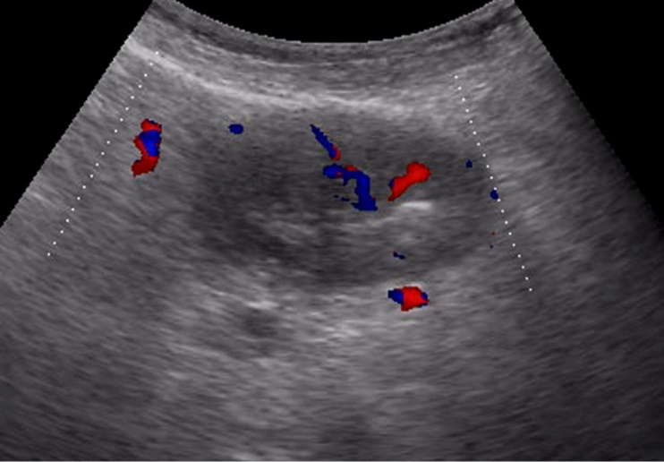 Metastatic affected lymph node in gastric cancer of the anterior wall of the stomach of stage T4. Significantly enlarged lymph node, echogenicity reduced, large vascular signals in color Doppler mode visible in the center.