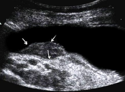 The polypoid type of gastric carcinomas for T3 stage. On the posterior wall of the antrum, a polypoid formation with a fuzzy contour is visualized, the image of the mucous and serous membranes (arrows) is discontinuous.