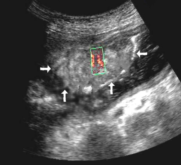 The gastric carcinoma for T3 stage. The tumor is visualized as a polypoid formation on a wide base above the gastric mucosa of a non-uniform structure, an irregular surface (arrows).