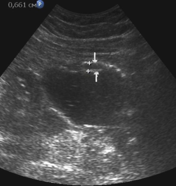 Diffuse infiltrative form of the gastric carcinoma of stage T2 on the anterior wall of the stomach (arrows). The integrity of the mucous layer is not broken.