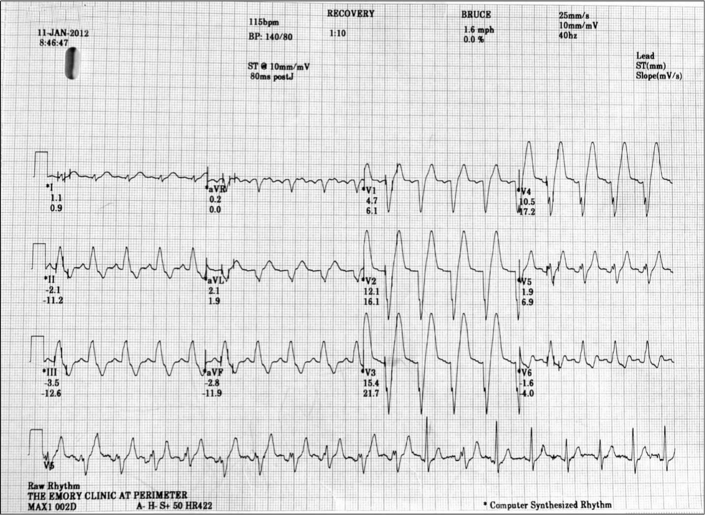 Complete LBBB developed during the later stages of the recovery period (115 bpm).