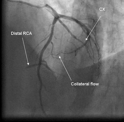 Collateral flow from circumflex artery (CX) to right coronary artery (RCA) in cranial left anterior oblique view.