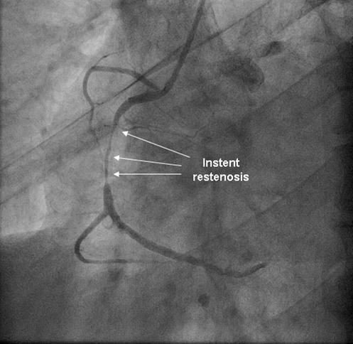 Instent restenosis in proximal RCA