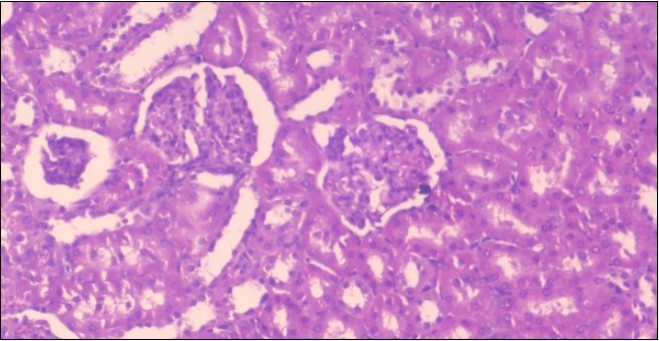 Photomicrogragh of kidney section of obese rat showing fatty degeneration of the tubules with eosinophilic matrial deposition, glomrerular atrophy with wide urinary space and distal tubules with extrusion of nuclei into lumen , (H&E) (40X).