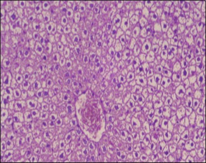 Photomicrograph of liver section of obese rat showing swollen hepatocytes with vacuolated cytoplasm filled with fatty infiltration, congested central vein and disappearance of blood sinusoids, (H&E) (40X).