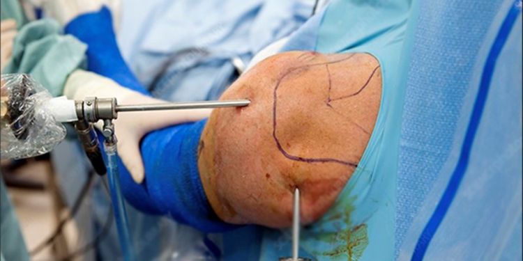 Article: Hybrid Limited Shoulder Surgical Management (HLSSM) Sayed Issa's Hybrid Shoulder Arthroscopic-Open Surgical Management