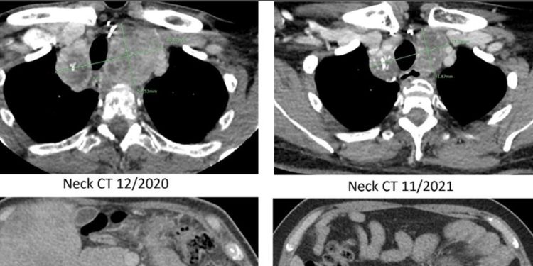 Article: RET 898-901Del mutant, a variant of unknown significance, has a durable response to Pralsetinib in a Medullary Thyroid Carcinoma patient