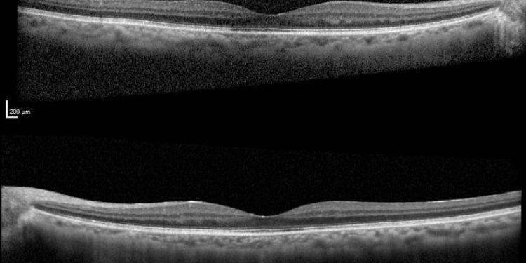 Article: Leflunomide-Induced Cystoid Macular Edema: A Rare Case Report